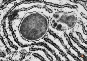 F,52y. | bone marrow - inclusions in plasmocytes F,52y. | bone marrow - inclusions in plasmocytes